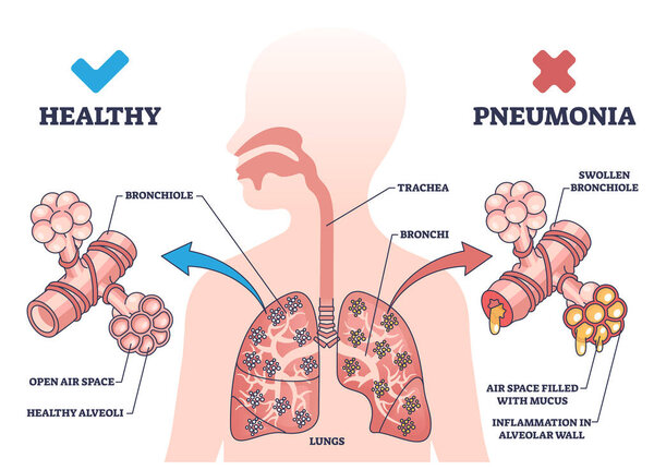 Pneumonia illness medical comparison with healthy lungs outline diagram. Respiratory system problem with bronchi wall inflammation and air filled with mucus vector illustration. Bacterial infection.