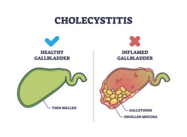 Cholecystitis as inflamed gallbladder compared with healthy outline diagram. Labeled educational scheme with swollen mucosa and gallstones in digestive tract vector illustration. Stomach disease. clipart