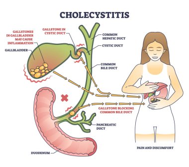 Cholecystitis as gallbladder inflammation from blocked gallbladder outline diagram. Labeled educational scheme with medical disease in digestive tract from gallstone vector illustration. Duct anatomy clipart