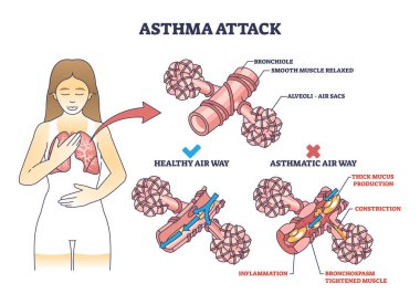 Asthma attack explanation compared with healthy air way outline diagram. Labeled educational scheme with mucus production and inflammation in lungs vector illustration. Anatomical respiration system. clipart