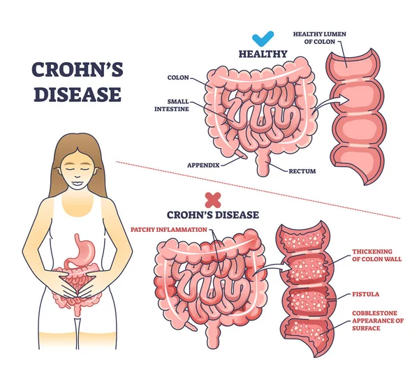 Enfermedad Crohns Como Problema Inflamatorio Intestinal Explicación Esquema Diagrama Comparación — Archivo Imágenes Vectoriales