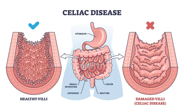 Celiac Disease Chronic Digestive Immune Disorder Outline Diagram Labeled Educational — Stock Vector