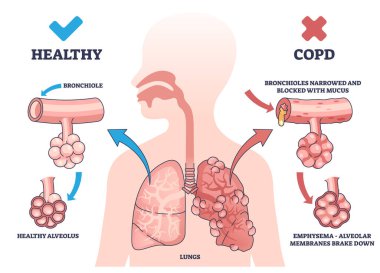 COPD ya da kronik obstrüktif akciğer hastalığı açıklama taslağı. Sağlıklı ve solunum hastalıkları olan etiketli tıbbi şema akciğerler vektör illüstrasyonunu karşılaştırıyor. Vücut tanısı