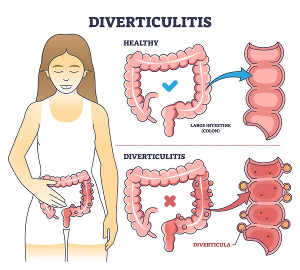 肠系膜炎作为大肠轮廓图的消化条件 带有结肠问题向量说明的标签教育方案 消化系统炎症的解剖学解释 — 图库矢量图片
