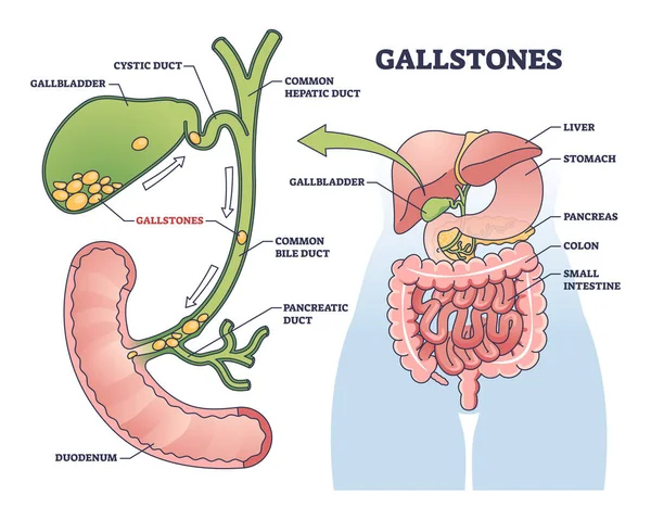 Gallstones Stones Cholesterol Gallbladder Outline Diagram Labeled Educational Scheme Bile — Stock Vector