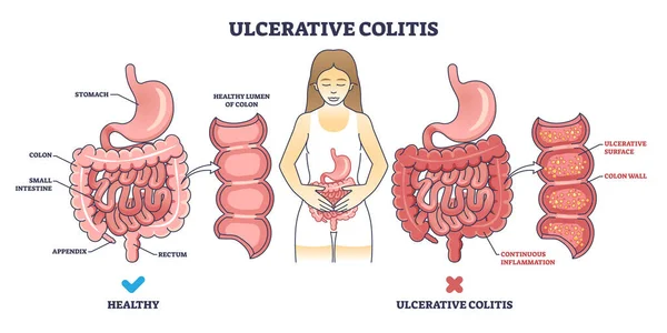 Ulcerative Colitis Chronic Inflammatory Bowel Disease Outline Diagram Labeled Educational — Stock Vector