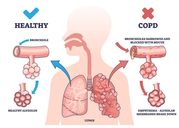Dpoc Doença Pulmonar Obstrutiva Crônica Esquema Explicativo Rótulo Esquema Médico — Vetor de Stock
