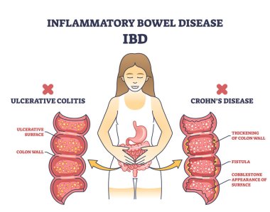 İltihaplı bağırsak hastalığı ya da Crohns hastalığı olan IBD ve ülseratif kolit şeması. Gastrointestinal yol vektör illüstrasyonunun kronik iltihaplanması ile etiketlenmiş eğitim şeması.