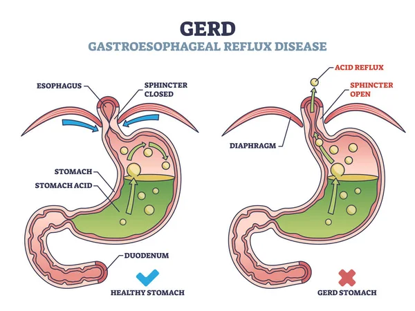 Gerd Gastroesophageal Reflux Disease Digestive Acid Outline Diagram Labeled Educational — Stock Vector