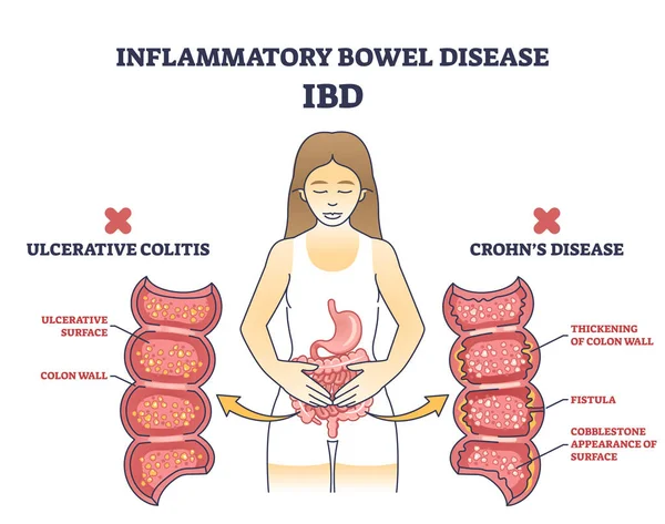 Inflammatory Bowel Disease Ibd Crohns Condition Ulcerative Colitis Outline Diagram — Stock Vector
