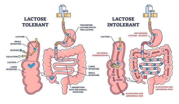 Lactose Intolerance Tolerance Medical Process Differences Outline Diagram Labeled Educational — Stock Vector