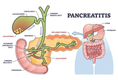 Pankreas iltihabı, kronik ya da akut safra taşı şeması kaynaklı pankreas iltihabı. Kanal anatomisi ve iltihaplı sindirim sistemi doku çizimi ile etiketlenmiş tıbbi şema.
