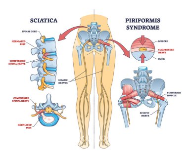 Sciatica vs piriformis medical muscle conditions comparison outline diagram. Labeled educational scheme with hip anatomy and compressed nerve or herniated disc caused acute pain vector illustration. clipart