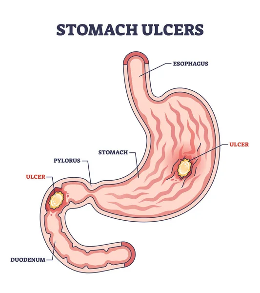 胃潰瘍として慢性胃の問題燃焼疼痛アウトライン図 腹部構造と医学炎症位置ベクトル図と教育解剖学的消化スキームラベル — ストックベクタ