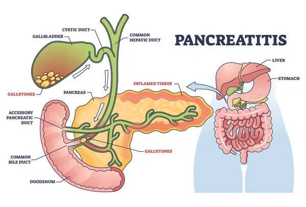Pancreatitis Pancreas Inflammation Chronic Acute Gallstones Outline Diagram Labeled Educational — Stock Vector