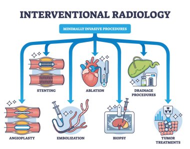 Interventional radiology as minimally invasive procedures outline diagram. Labeled educational scheme with medical biopsy treatment process for tumors, stenting and angioplasty vector illustration. clipart