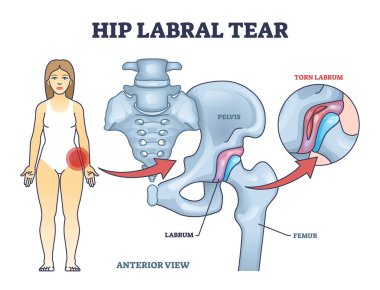 Tıbbi labrum kemik hasarı şeması ile kalça labral yırtılması anatomik açıklama. Leğen kemiği, kalça kemiği ve yırtık labrum durumu örnekleme ile eğitimsel iskelet anatomisi.