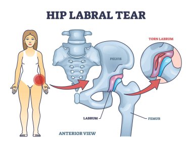 Hip labral tear anatomical explanation with medical labrum bone damage outline diagram. Labeled educational skeletal anatomy with pelvis, femur and torn labrum condition example vector illustration. clipart