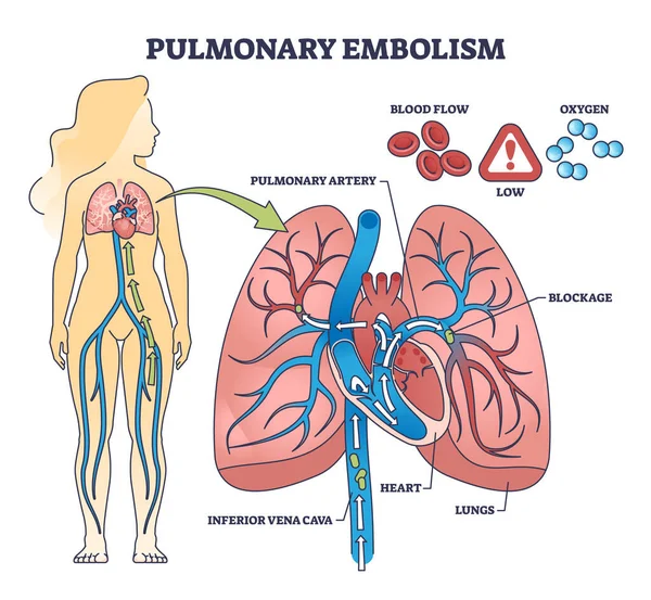 Stock vector Pulmonary embolism with blood flow blockage in lung artery outline diagram. Labeled educational scheme with clot and thrombus from inferior vena cava vector illustration. Stroke disease and condition