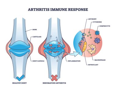 Romatoid kemik hastalığı şeması ile bağışıklık sistemi tepkisi. Acı verici eklemleri ve iltihaplanma vektör illüstrasyonuyla etiketlenmiş tıbbi durum. Kıkırdak kronik sorunu.