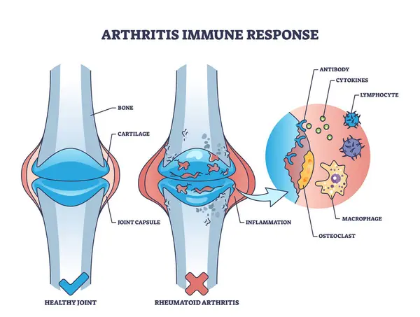 Artritida Imunitní Odpověď Revmatoidní Kostní Onemocnění Obrys Diagram Označené Vzdělávací — Stockový vektor