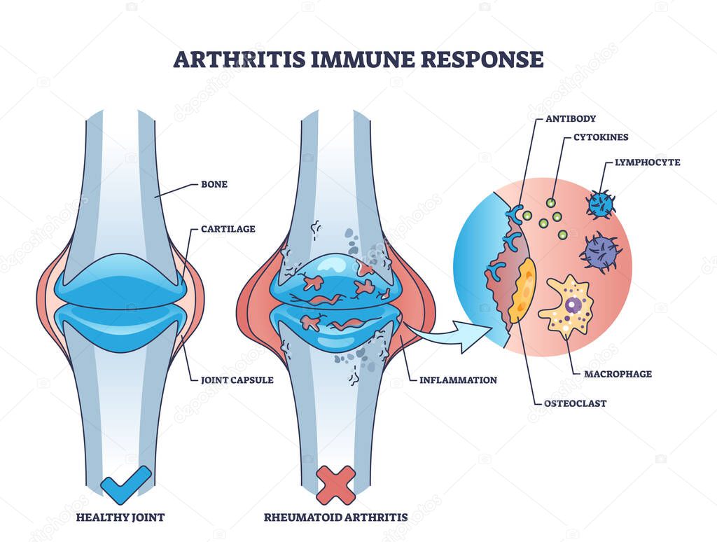 Artritis respuesta inmune con enfermedad ósea reumatoide esquema ...