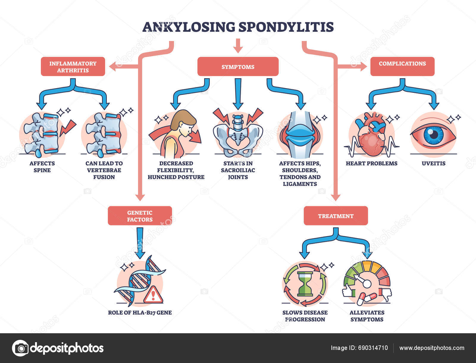 Ankylosing Spondylitis Arthritis Symptoms Complications Outline Diagram ...
