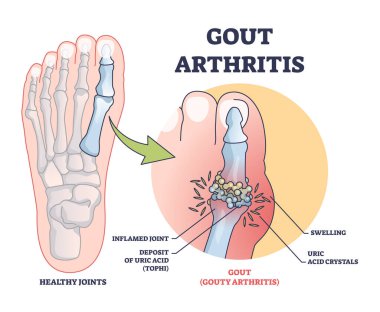 Gouty arthritis with inflamed toe joint painful condition outline diagram. Labeled educational scheme with medical disease and foot swelling from uric acid crystals deposition vector illustration. clipart