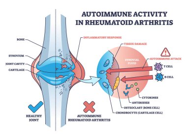 Autoimmune activity in rheumatoid arthritis skeletal disease outline diagram. Labeled educational scheme with body immune system attack to tissues with cells vector illustration. Bone inflammation. clipart