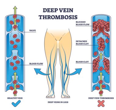 Deep vein thrombosis condition with blood clot blockage outline diagram. Labeled educational comparison with healthy vein and dangerous flow vector illustration. Cardiovascular disease explanation. clipart