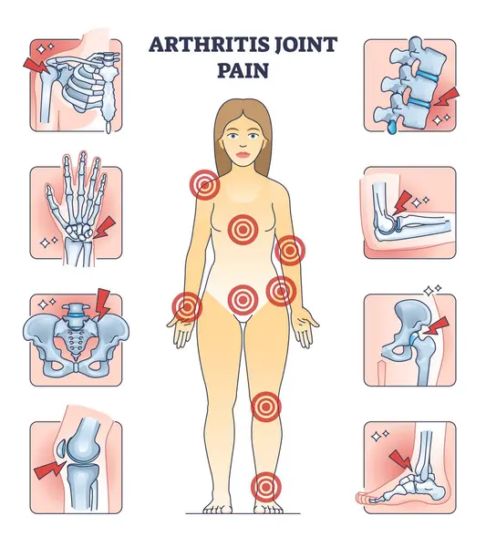 关节炎关节疼痛与受影响部位在人体示意图上 有解剖性慢性或急性疾病媒介的疼痛骨骼部位 骨骼发炎 — 图库矢量图片