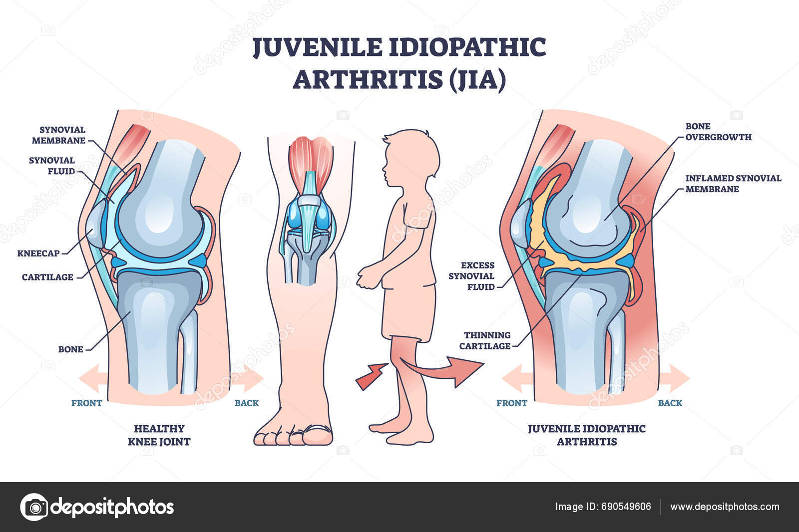 Juvenile Idiopathische Arthritis Oder Jia Anatomische Erklärungsskizze