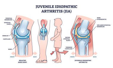 Juvenile idiyopatik artrit veya JIA anatomik açıklama taslağı. Sağlıklı ve hastalıklı birleşik karşılaştırma vektörü illüstrasyonuyla etiketlenmiş tıbbi şema. Çocuk kemik hastalığı.