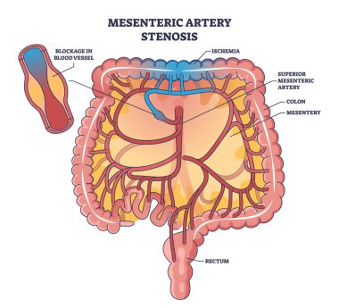 Mezenterik arter stenozu, kan damarı anahat diyagramında tıkanma olarak görülüyor. Abdomen ve sindirim sistemi sağlık vektörü çizimi için tehlikeli tıbbi koşullara sahip etiketli eğitim şeması.