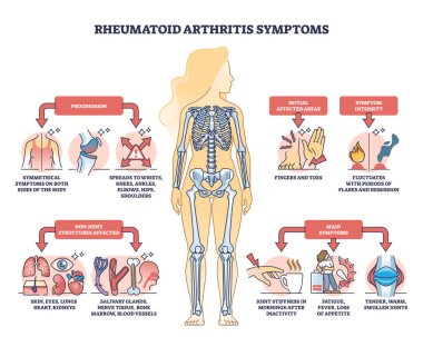 Rheumatoid arthritis symptoms with joint inflammation disease outline diagram. Labeled educational chronic illness description scheme with progression and affected body areas vector illustration. clipart