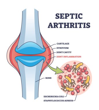 Septic arthritis joint inflammation with medical explanation outline diagram. Labeled educational scheme with leg bone anatomy and bacterial escherichia coli infection closeup vector illustration. clipart