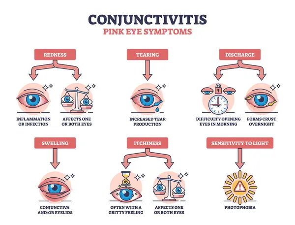 結膜炎またはピンクの目の症状 医学の例では 図を概説しています 影響を受けた赤み かゆみ 軽いベクターのイラストへの感受性のラベル付けされた教育スキーム — ストックベクタ