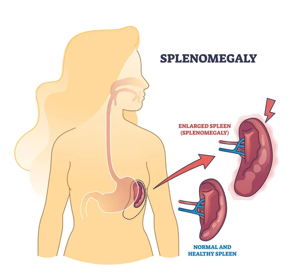 Splenomegali Symptom Som Forstørret Milt Forhold Til Friskt Organ Omrissdiagram – stockvektor