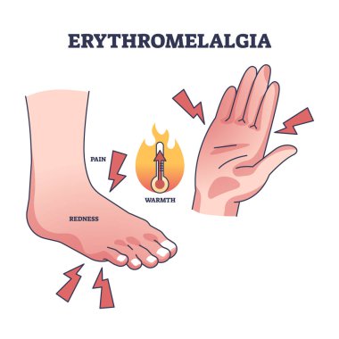 Erythromelalgia syndrome caused redness, pain or warmth outline diagram. Labeled educational scheme with foot, palm or hands burning sensations from red blood cells overproduction vector illustration clipart