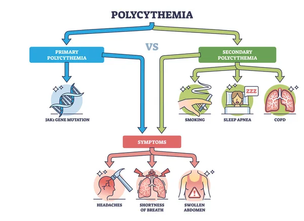 stock vector Polycythemia or erythrocytosis as red cells overproduction and increased blood mass outline diagram. Labeled educational scheme with primary, secondary disease stages and symptoms vector illustration