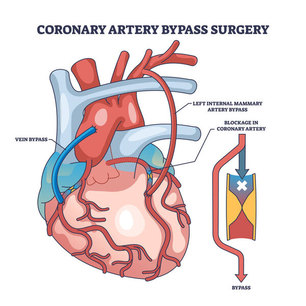 Coronary artery bypass surgery for blocked blood flow outline diagram. Labeled educational scheme with heart procedure and cardiology condition vector illustration. Medical cardiovascular treatment.