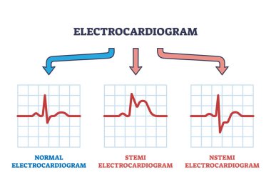 Elektrokardiyogram STEMI ve NSTEMI anormal kalp atış hızı diyagramı. Kalp atışı dalga analizi ve muhtemel kardiyovasküler hastalık teşhisi çizimi ile etiketlenmiş eğitim şeması.