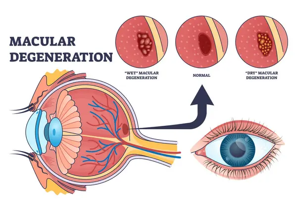 黄斑变性作为眼疾和视力问题的轮廓图 带有湿型或干型病媒图解的中央视力丧失疾病标签教育方案 医疗视网膜健康 — 图库矢量图片