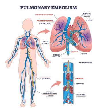 Pulmoner embolizm diyagramı akciğer atardamarını tıkayan bir kan pıhtısının emboliyi, akciğerleri ve kan damarlarını renklendirdiğini gösteriyor. Özet diyagramı