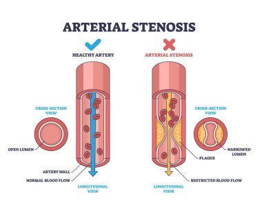 Atardamar stenozu, sağlıklı bir atardamar ve daralmış bir arteri plakla karşılaştırılarak gösterilir, kısıtlı kan akışı vurgulanır. Özet diyagramı