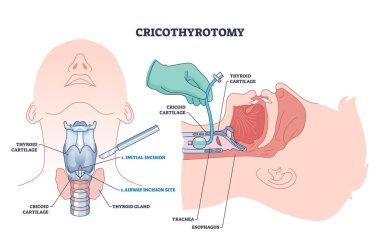 Cricothyrotomy prosedür diyagramı ensizyon, hava yolu ve acil hava yolu erişimi için anatomik işaretler gösteriyor. Özet diyagramı