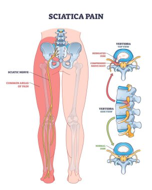 Siyatik ağrı, vurgulanmış sinir, ağrı bölgeleri ve omurga yapısı ile gösterilir, bu da nedenleri ve etkilenen bölgeleri gösterir. Özet diyagramı