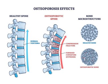 Osteoporoz diyagramı, sağlıklı osteoporotik omurga ve kemik mikro yapısına karşı, omurgayı, kırıkları ve kemik yoğunluğu kaybını gösteriyor. Özet diyagramı
