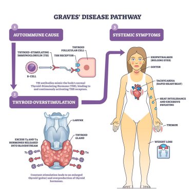 Graves disease pathway brief diagram explains autoimmune antibodies overstimulating the thyroid with a patient figure showing symptoms, thyroid, antibodies, woman. Outline diagram