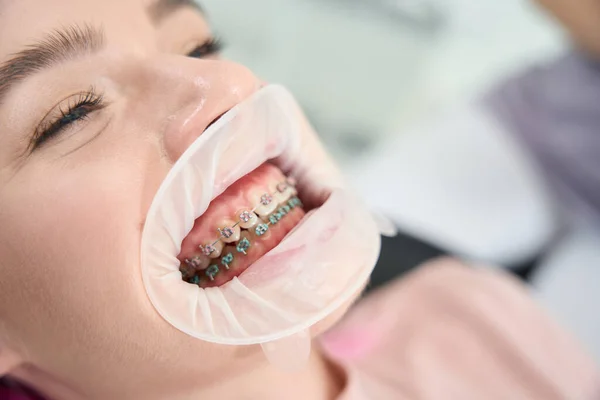 Detailní Fotografie Ženy Systémem Pro Korekci Zubního Kazu Zubního Zádržného — Stock fotografie